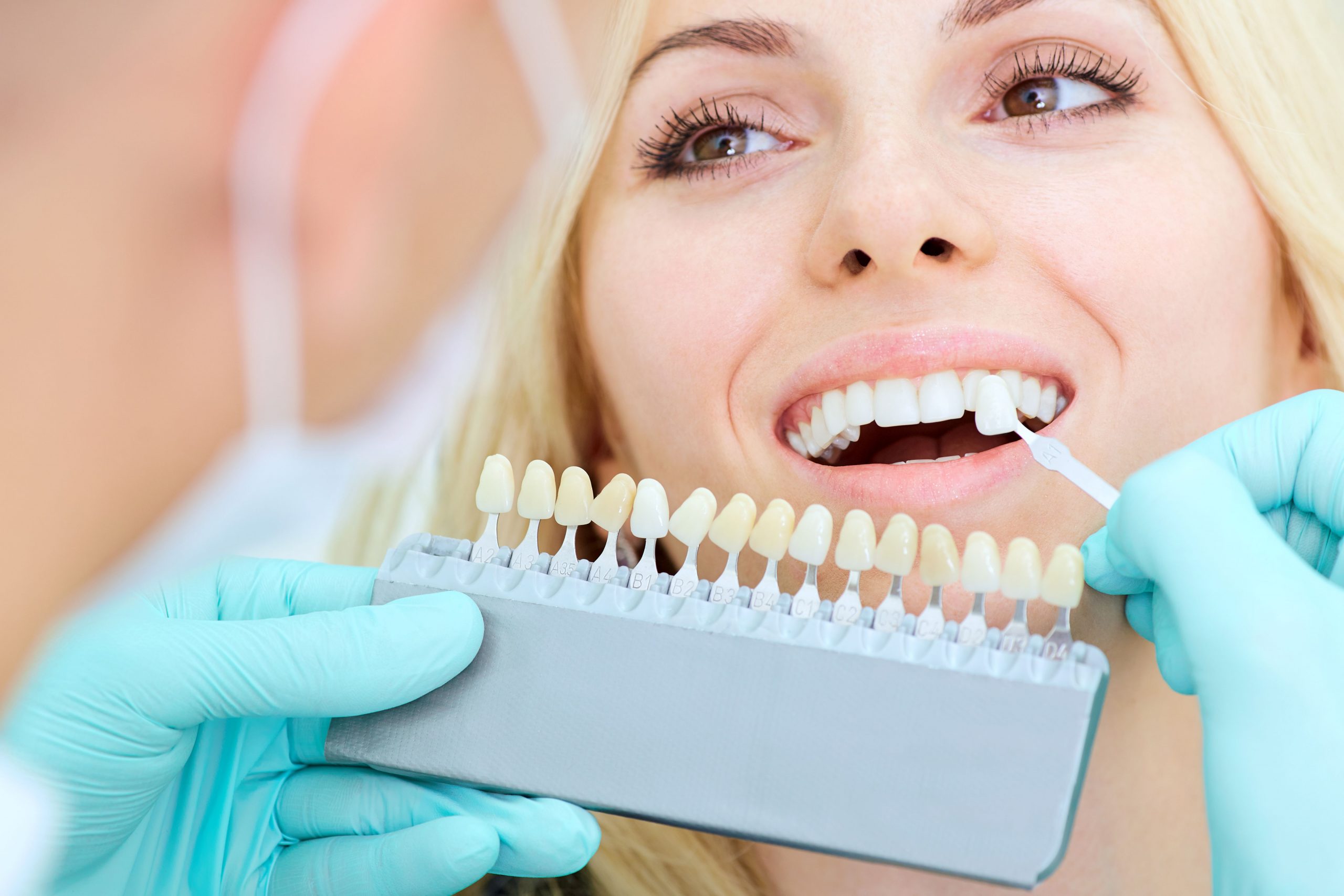 choosing a dental veneer